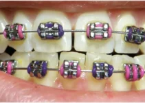 Cost of Dental (Teeth) Braces in South Africa